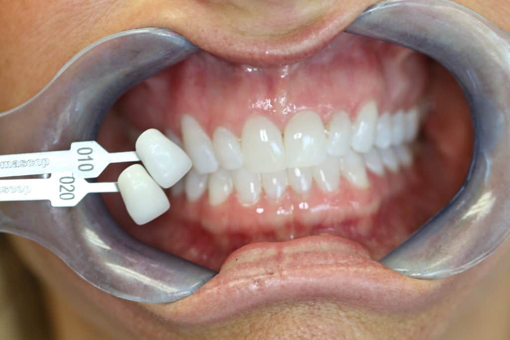 Teeth whitening