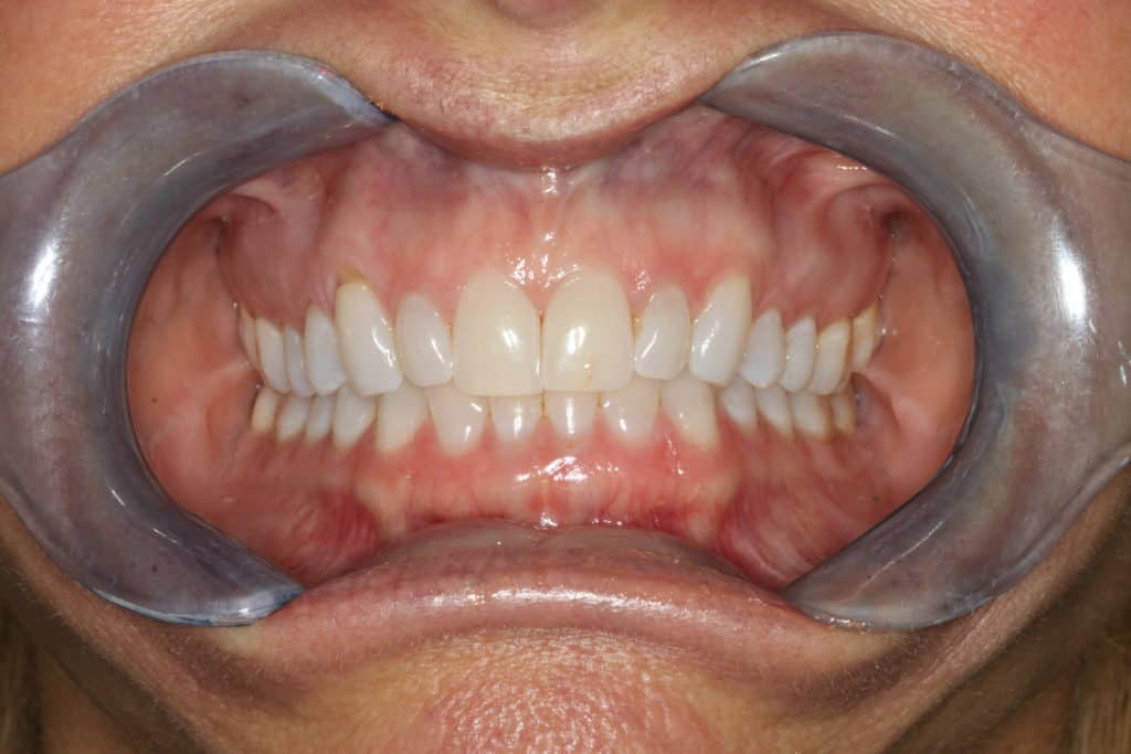 teeth whitening